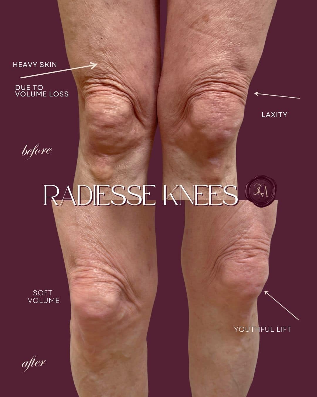 Before and After Image: Injectables Case 9 - front