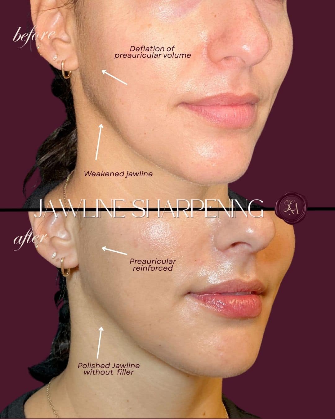 Before and After Image: Injectables Case 8 - front