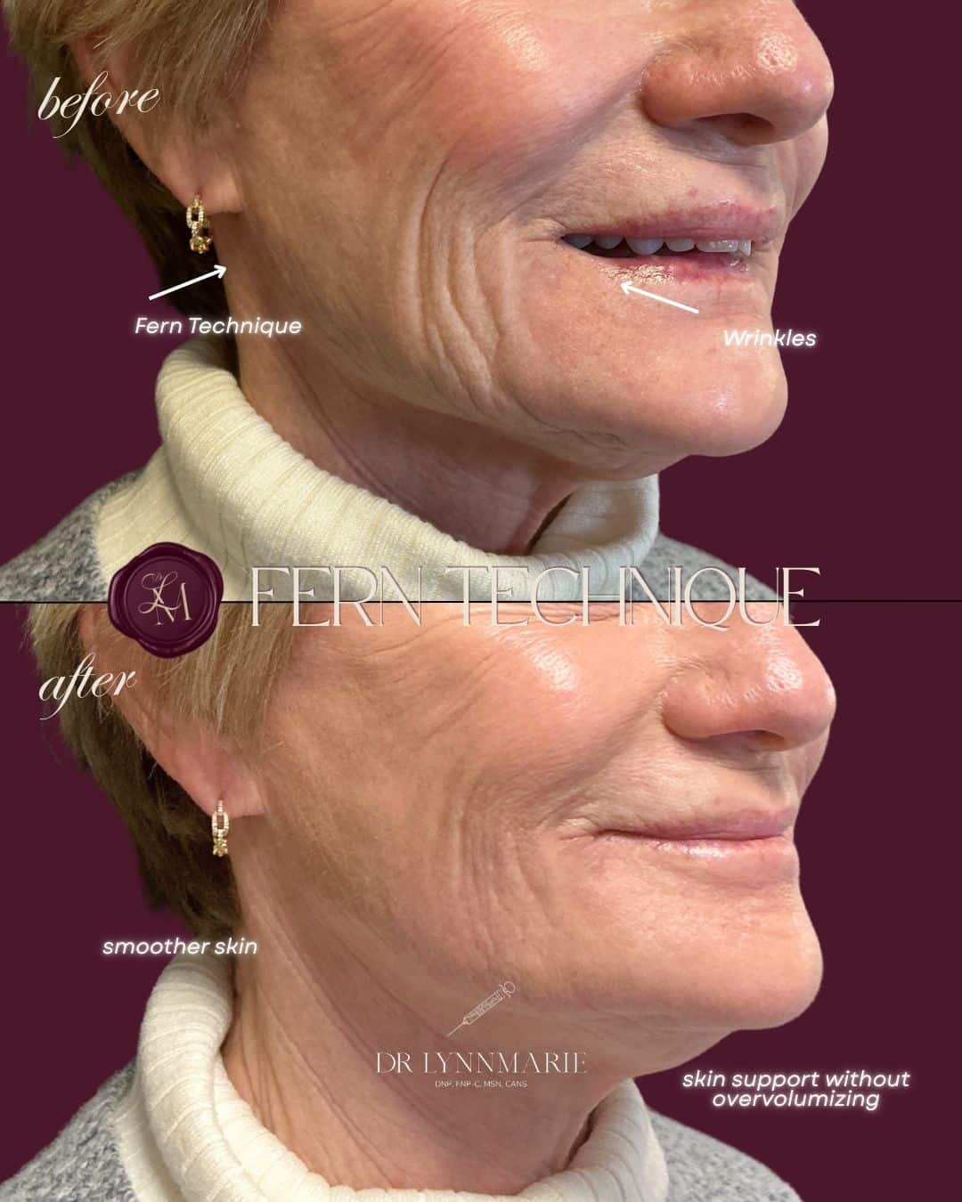 Before and After Image: Injectables Case 6 - right-front-oblique