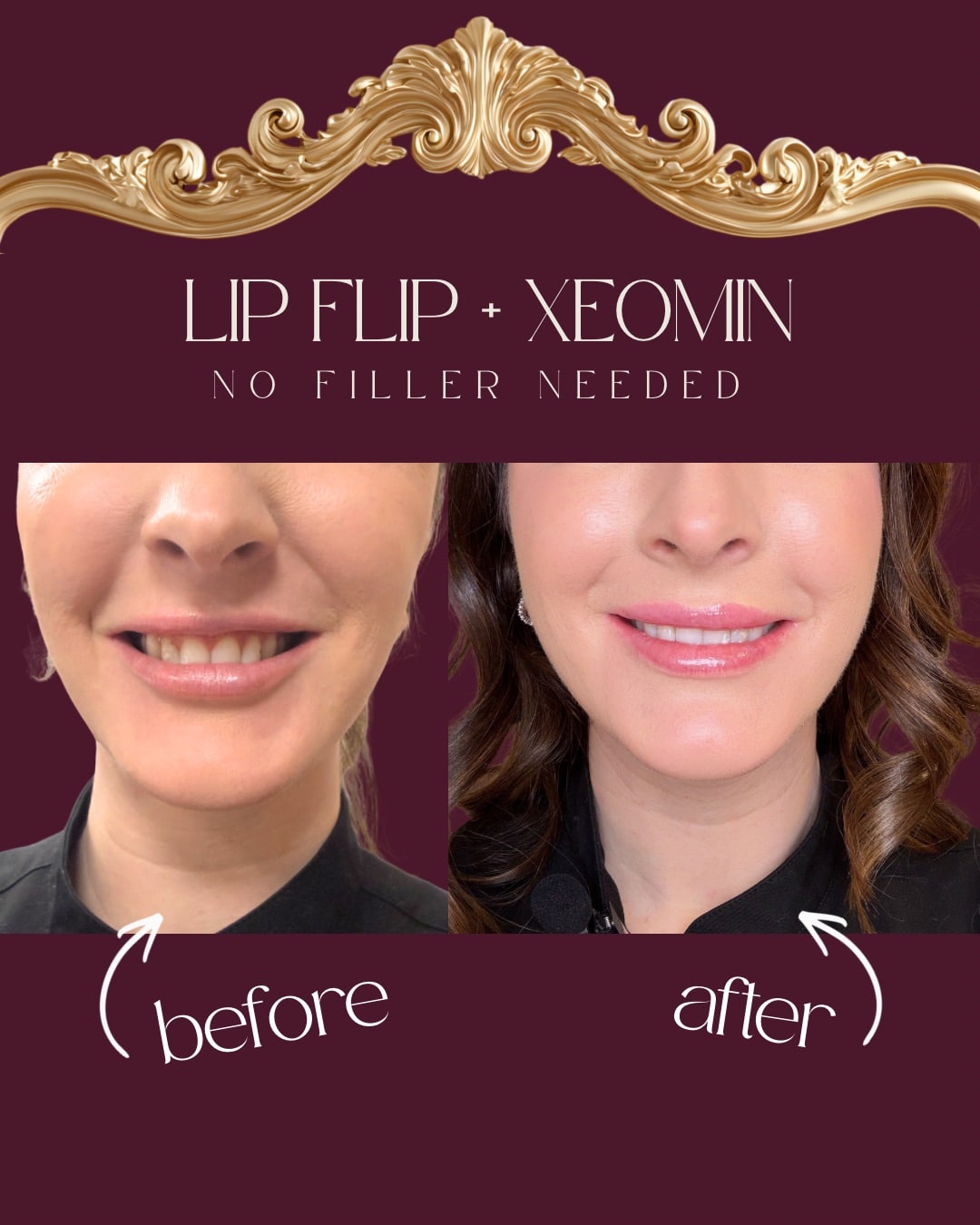 Before and After Image: Injectables Case 5 - front