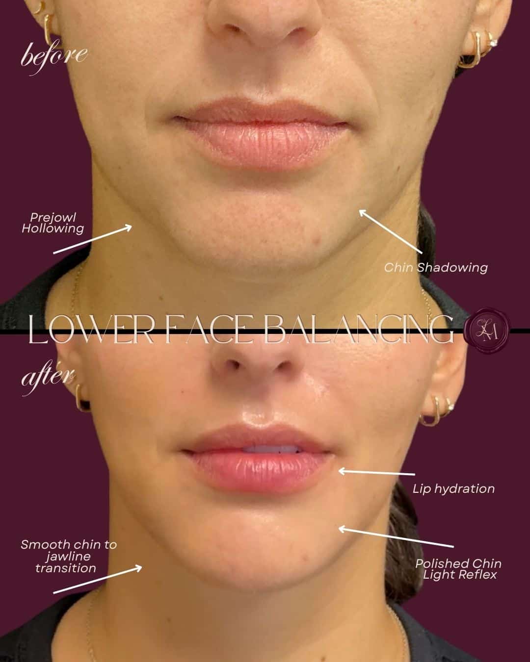 Before and After Image: Injectables Case 4 - front