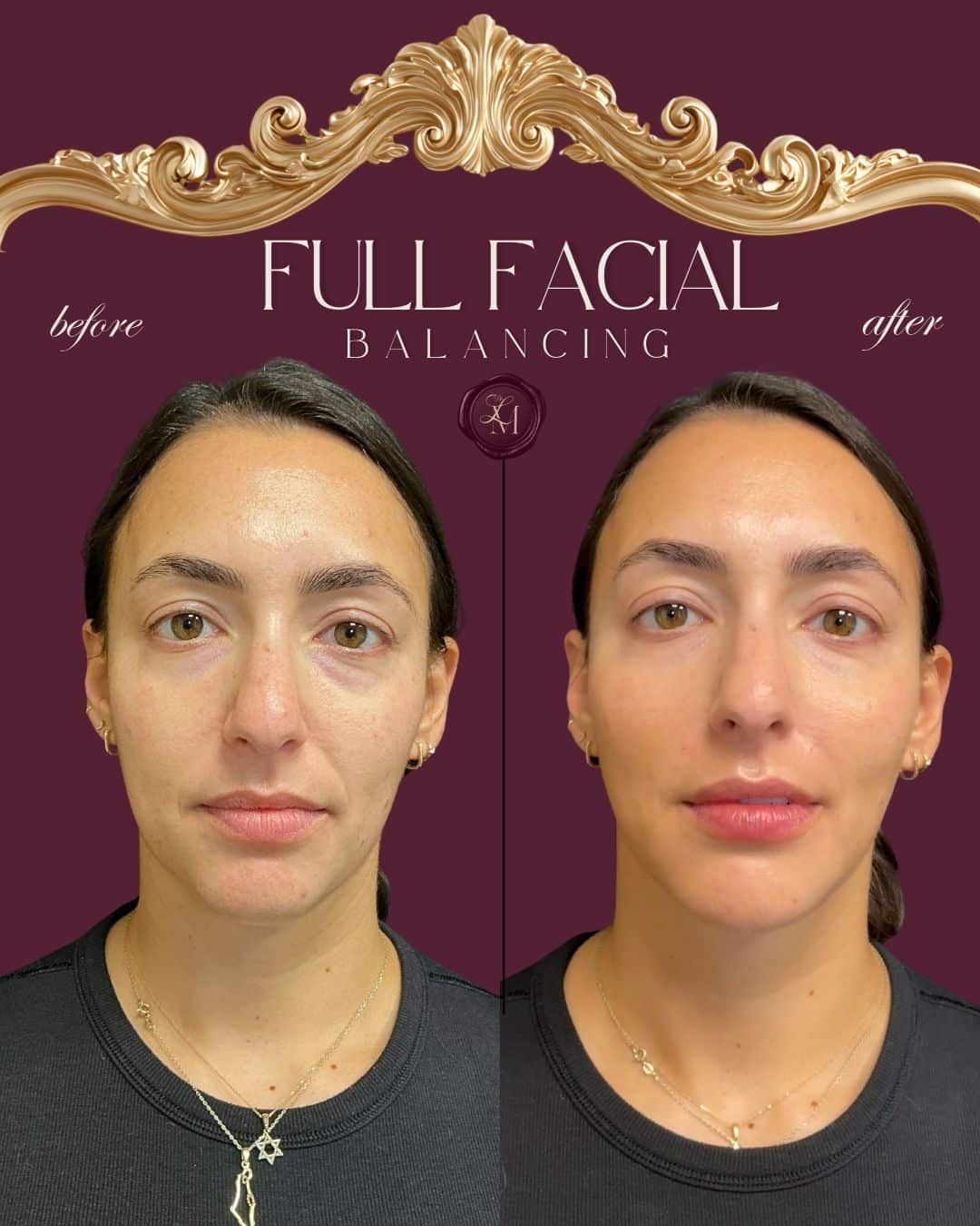 Before and After Image: Injectables Case 3 - front