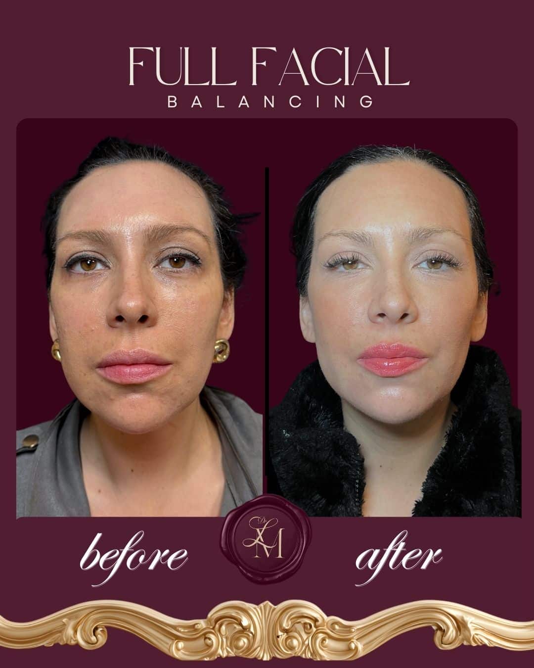 Before and After Image: Injectables Case 2 - front
