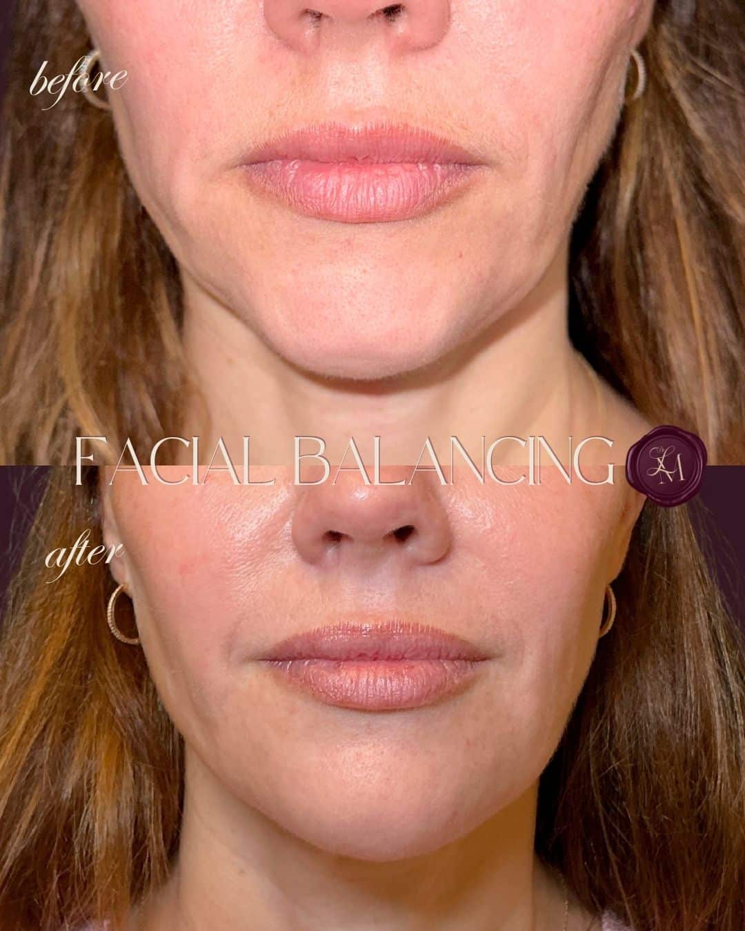 Before and After Image: Injectables Case 1 - front